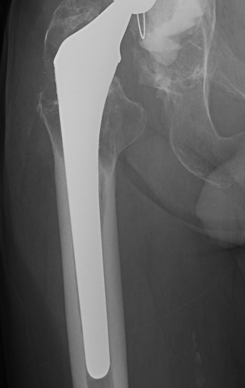 THR Proximal Stress Shielding